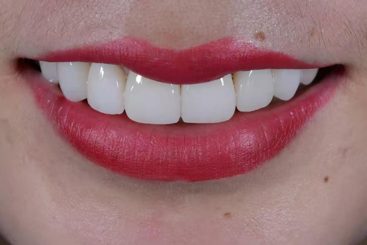 Latest company case about From Digital Design to Natural Beauty — A Veneer Case Crafted for Real-Life Smiles
