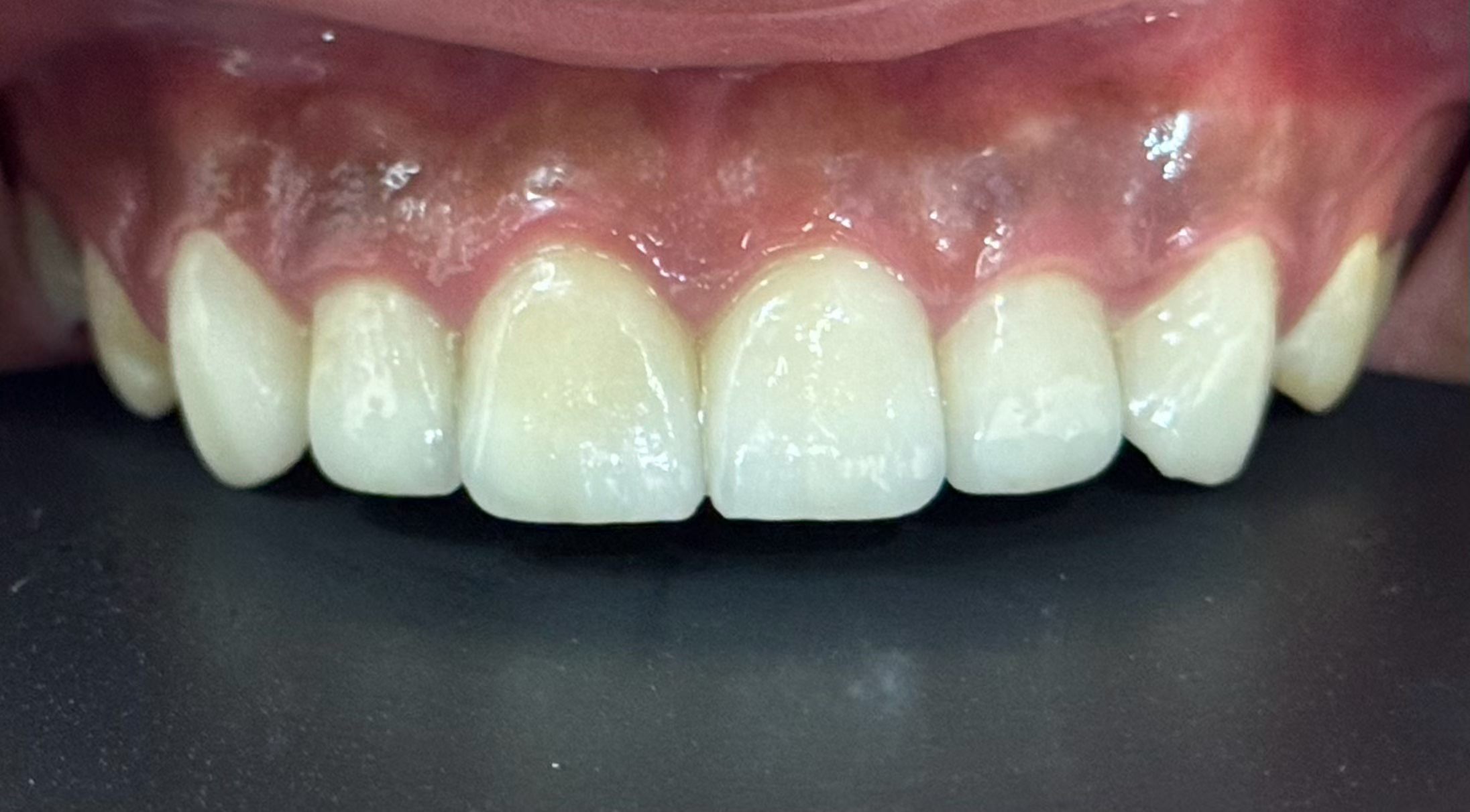 Latest company case about From Periodontal Rehabilitation to Functional Restoration: Real‑World Cases of Aesthetic & Implant Dentistry in China